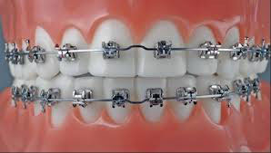 braces